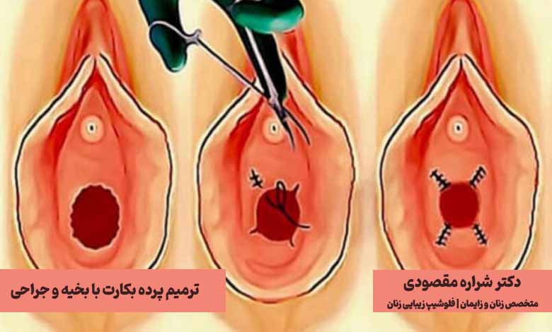 ترمیم پرده بکارت با جراحی و بخیه