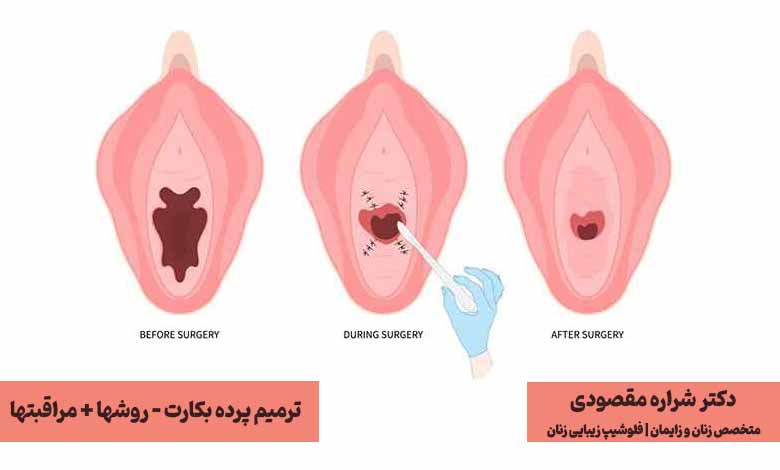 ترمیم پرده بکارت چیست