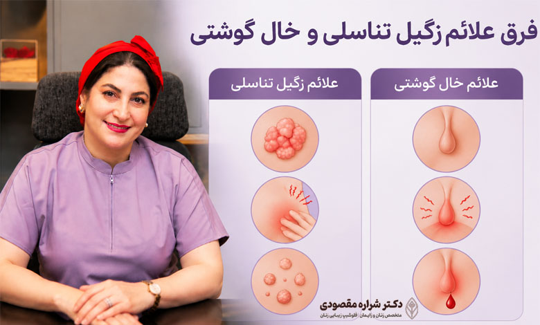 فرق علائم زگیل تناسلی و خال گوشتی