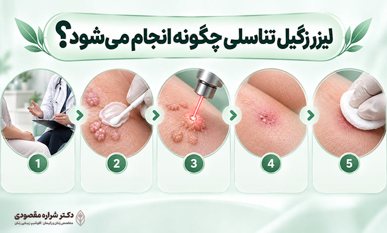 لیزر زگیل تناسلی چگونه انجام می شود؟