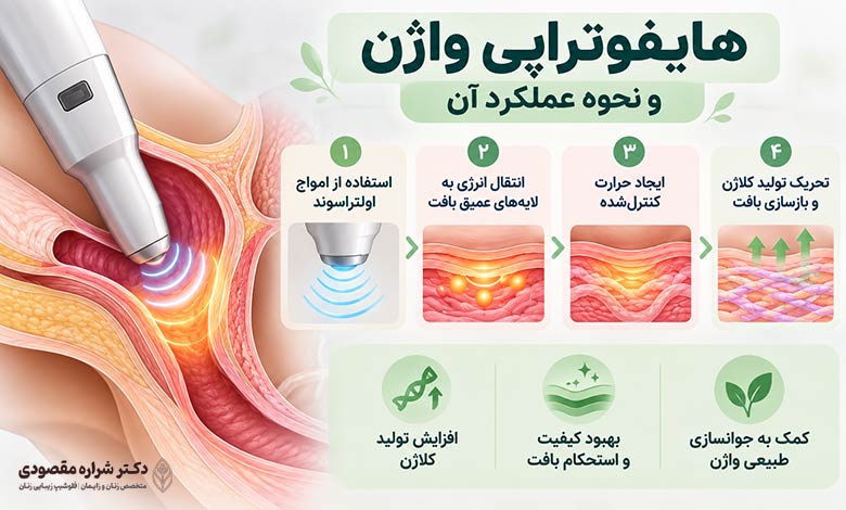هایفوتراپی واژن و نحوه عملکرد آن