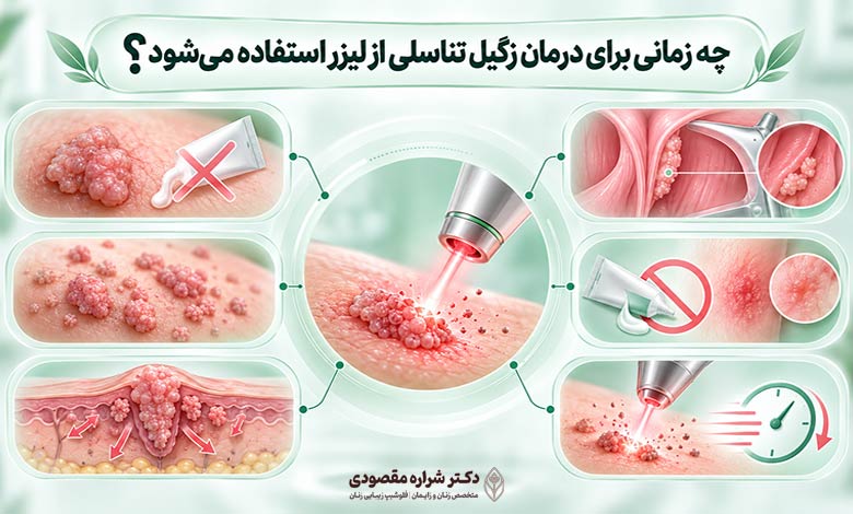چه زمانی برای درمان زگیل تناسلی از لیزر استفاده می شود؟