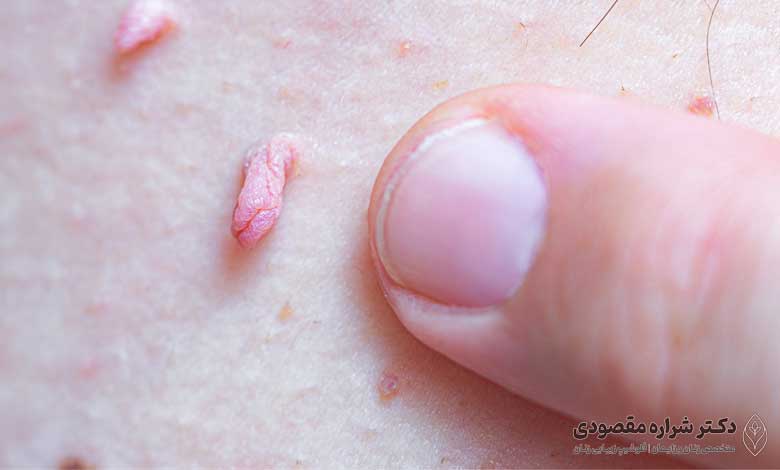 عود زگیل تناسلی و دلایل آن 