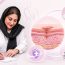 گوشت اضافه بعد از لابیاپلاستی چیست؟